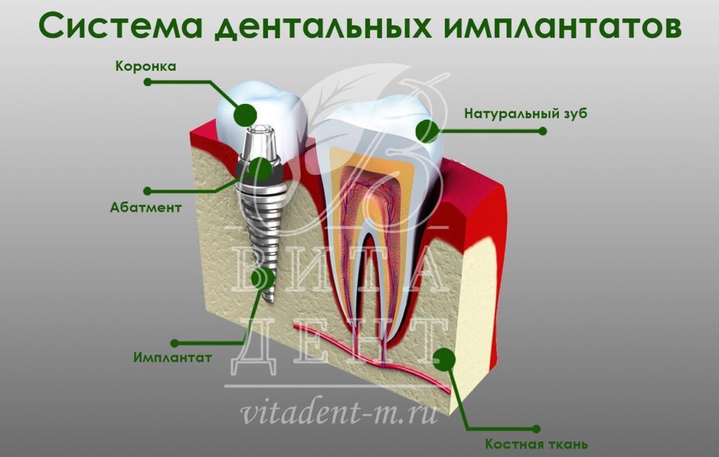 Анатомические предпосылки стоматологической имплантации презентация