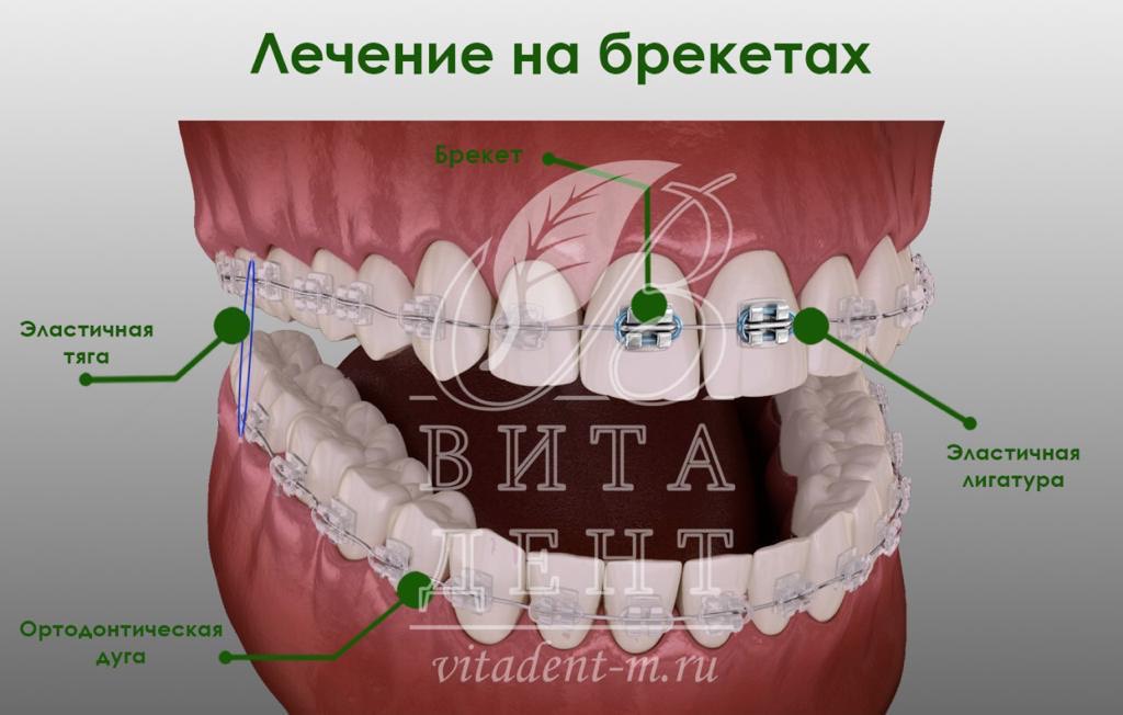 Твинблок ортодонтия картинки